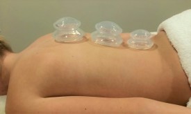 cupping-pic